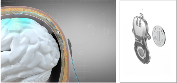癱瘓患者已能下床！上海完成首例腦機(jī)接口產(chǎn)品臨床試驗(yàn)植入手術(shù)